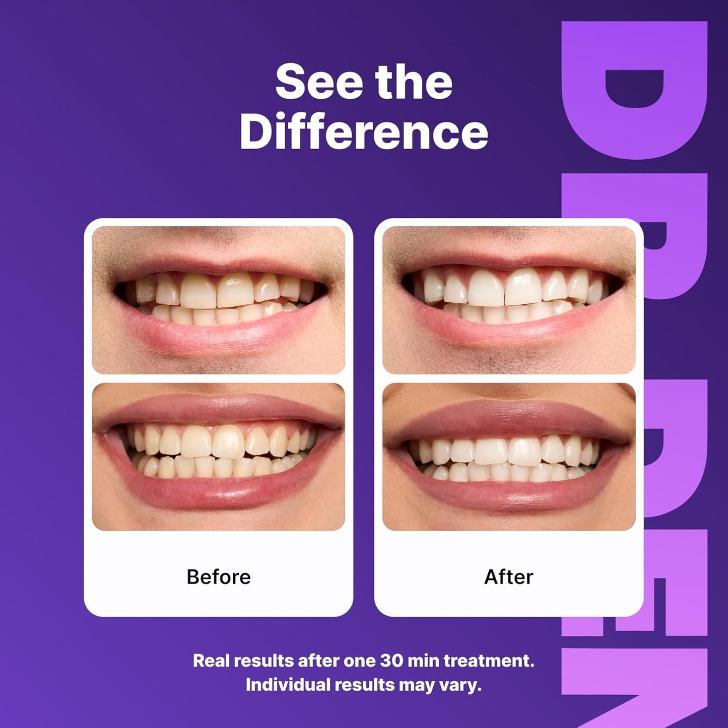 DRDENT Purple Teeth Whitening Strips 21 Treatments