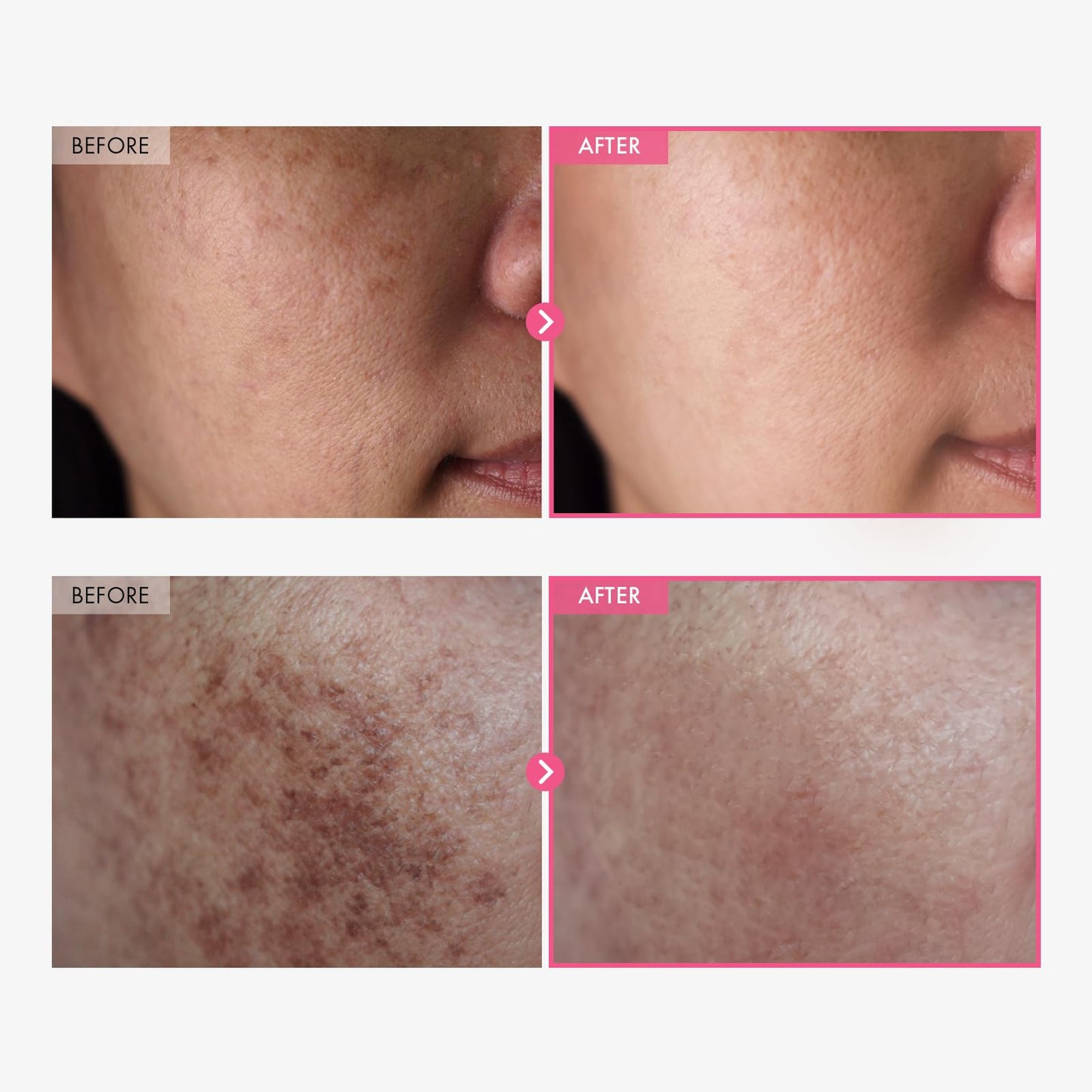 La Roche-Posay Mela B3 Serum, Dark Spot Corrector With Anti-Aging Melasyl